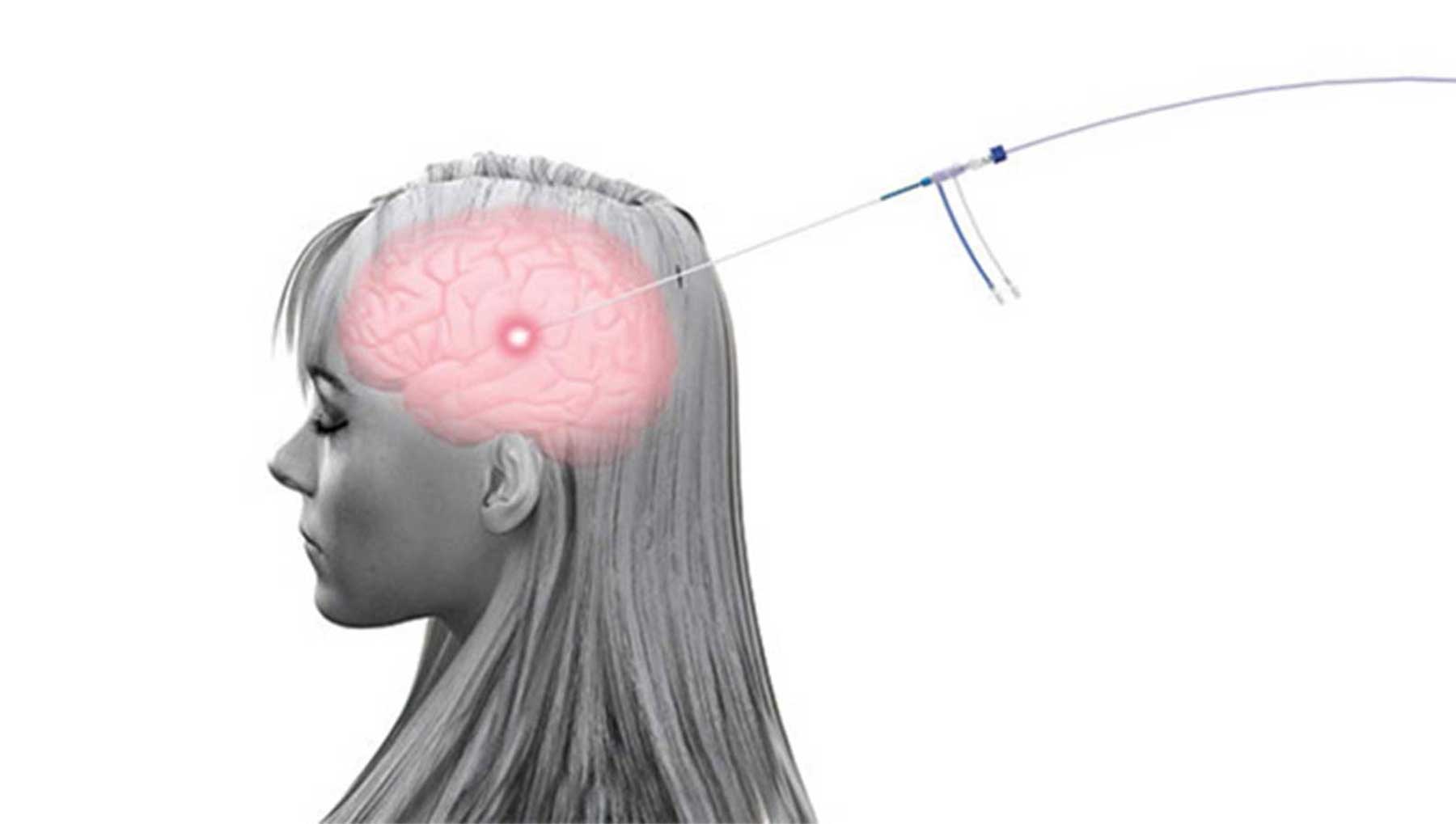 Laser Ablation Brain Surgery Side Effects