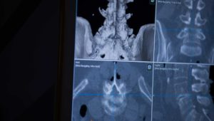 Spinal Surgery Outcomes