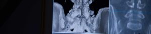 Spinal Surgery Outcomes