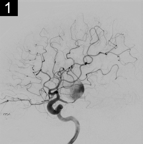 giant-aneurysm-1- Brown Neurosurgery