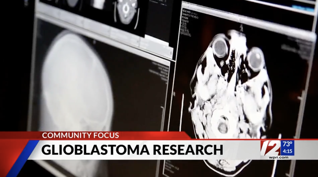 Dr. Eric Wong Discusses Emerging Treatments for Glioblastoma and Tumor ...